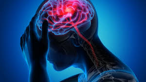 Imagen destacada - Accidente cerebro vascular