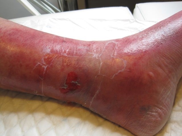 Imagen destacada - Celulitis 2022. Tratamiento