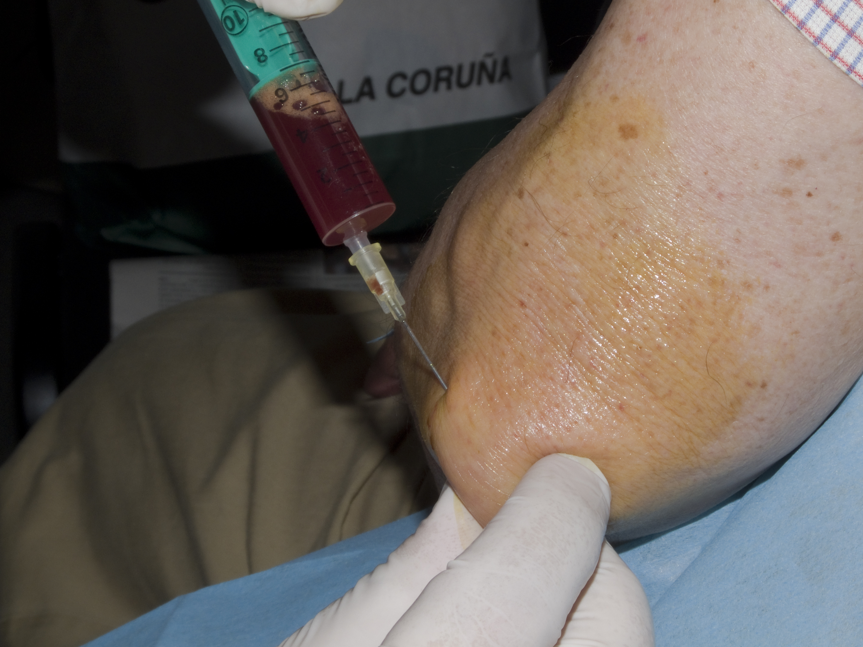 Imagen destacada - Infiltración de las bursitis