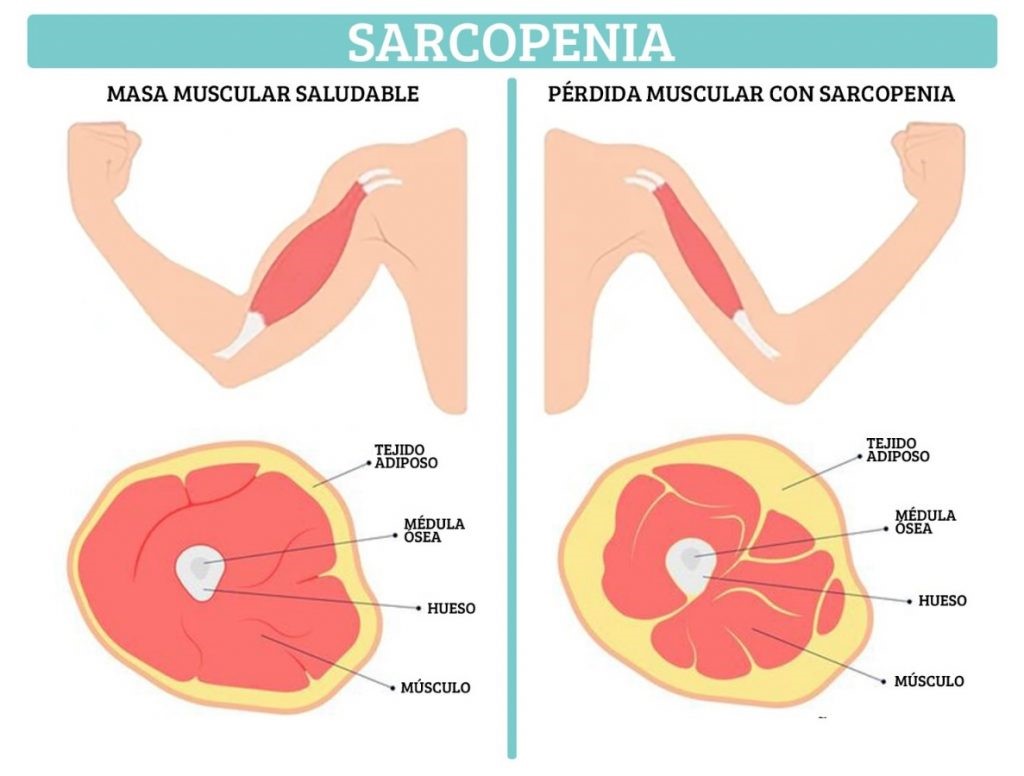Imagen destacada - Valoración de la Fragilidad y de la Sarcopenia