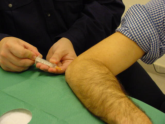 Imagen destacada - Infiltración de las tendinitis