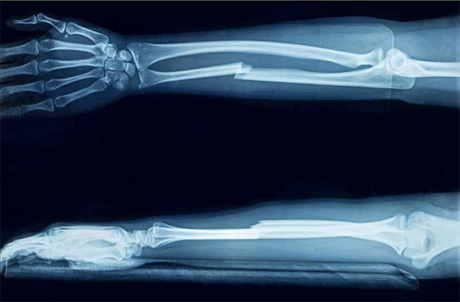 Imagen destacada - Prevención secundaria de la fractura osteoporótica tras fractura por fragilidad en adulto mayor.