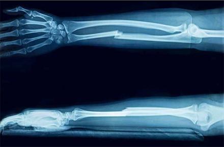 Imagen destacada - Prevención secundaria de la fractura osteoporótica tras fractura por fragilidad en adulto mayor.