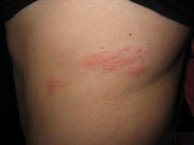 Imagen destacada - Herpes zoster 2022