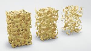 Imagen destacada - Osteoporosis 2026