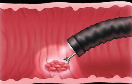 Imagen destacada - Colonoscopia. Criterios petición en cáncer colorrectal hereditario