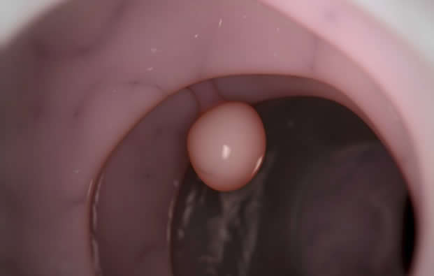 Imagen destacada - Colonoscopia. Control pólipos