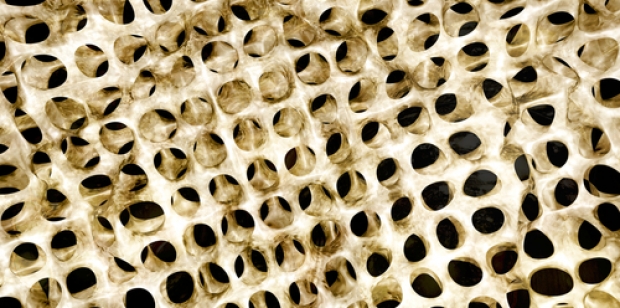 Imagen destacada - Osteonecrosis mandibular por uso de antireabsortivos