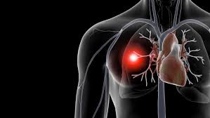 Imagen destacada - TROMBOEMBOLISMO PULMONAR